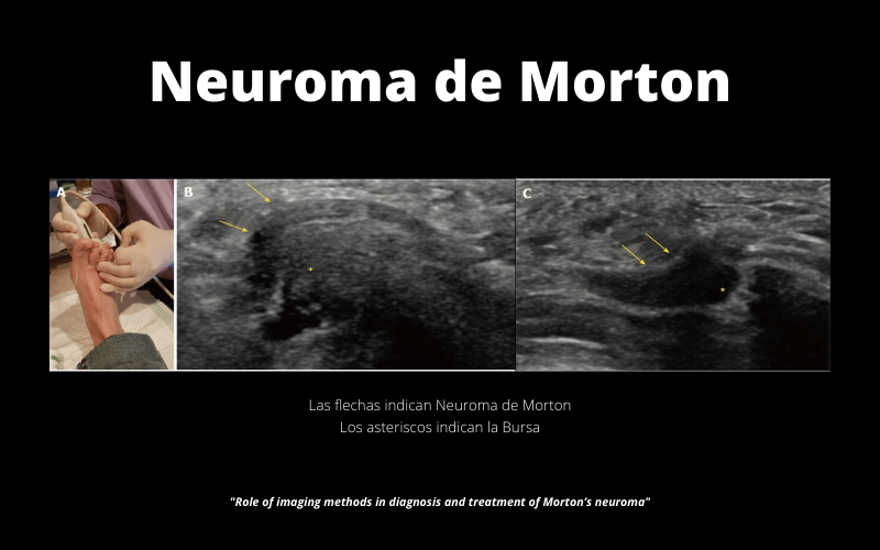 Neuroma Morton 2.png